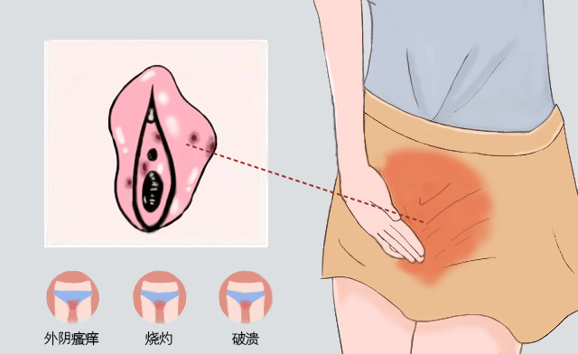 外阴痒是什么原因造成的?