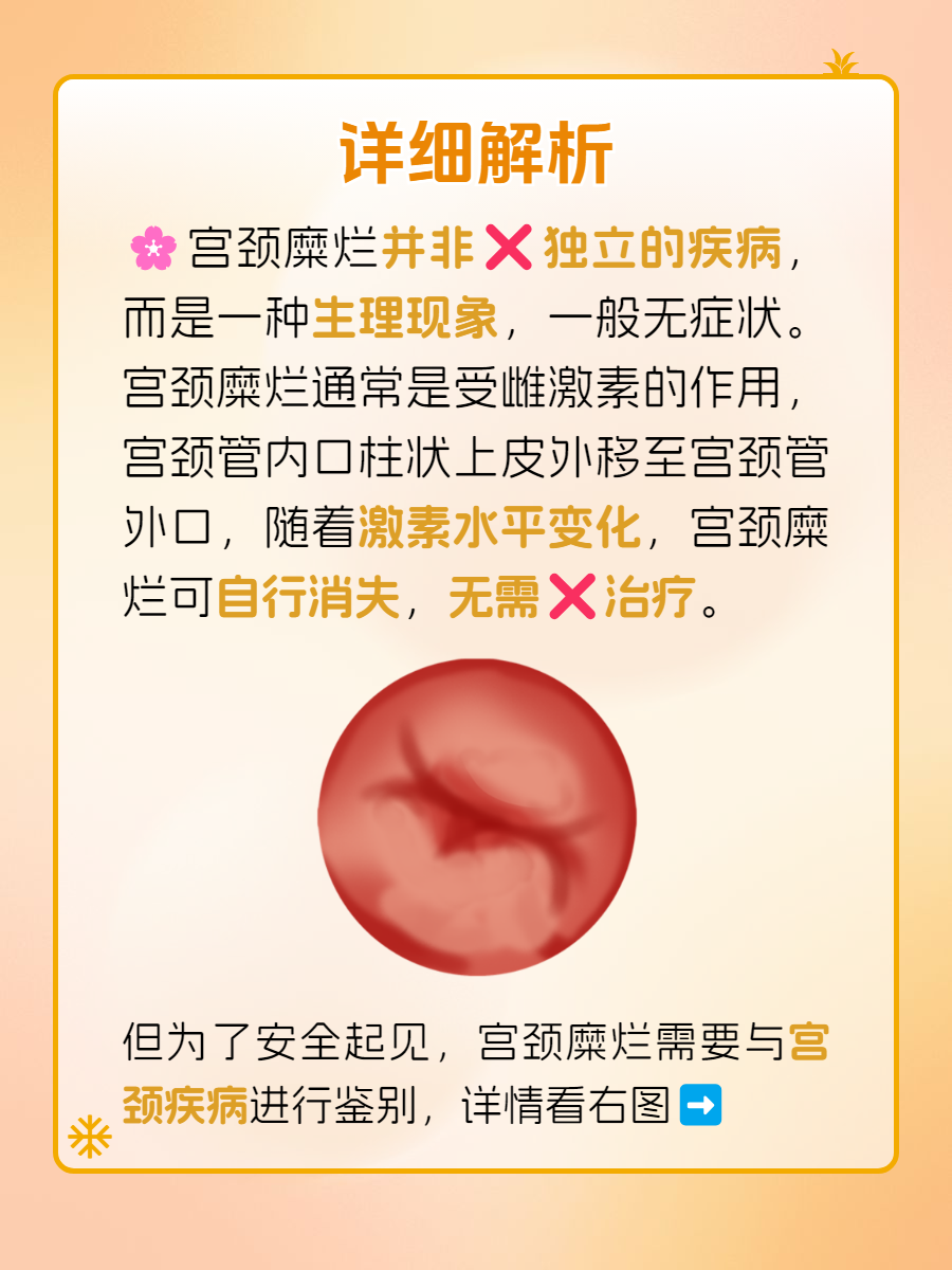 宫颈糜烂需要治疗吗?