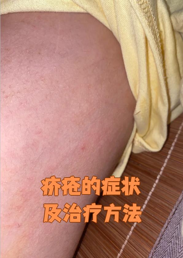 疥疮的最佳治疗方法是什么?