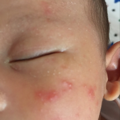 满月婴儿脸上起小红点