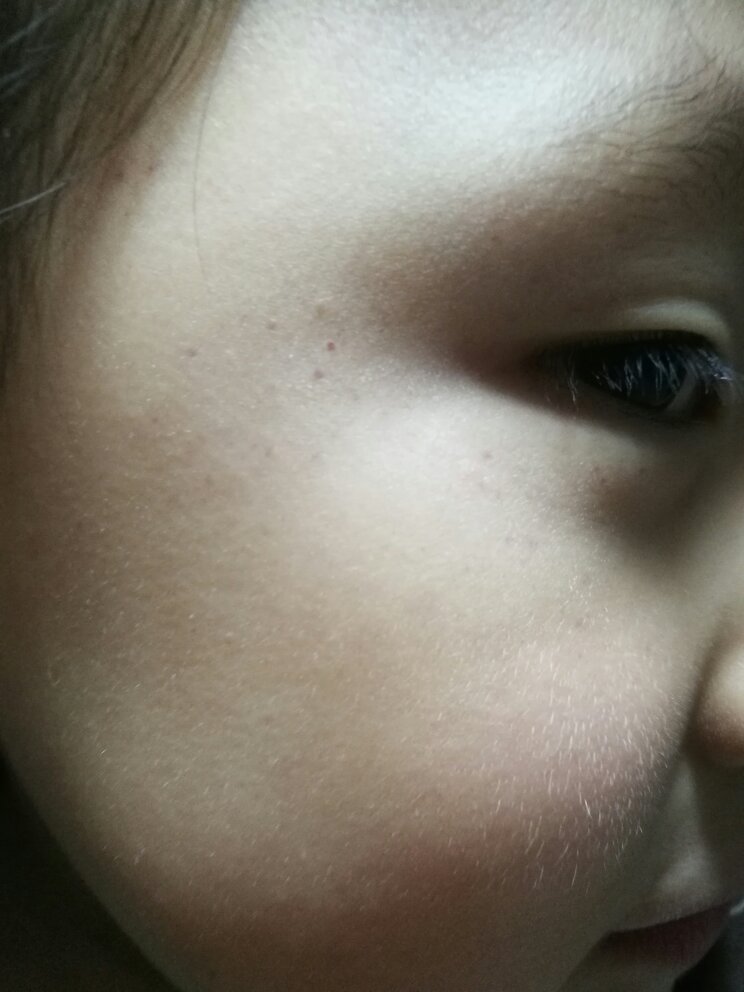 满月婴儿脸上起小红点
