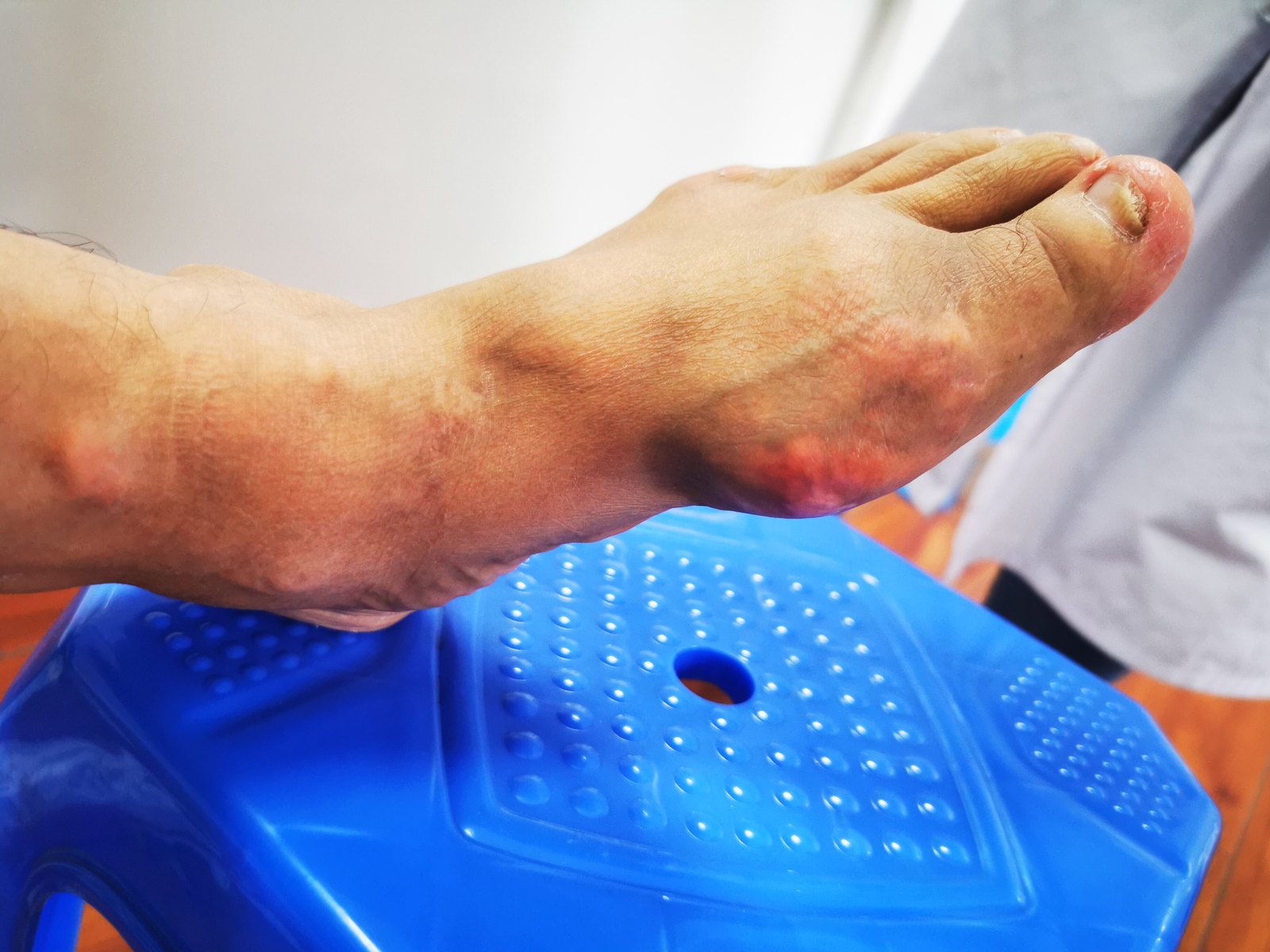 慢性外阴炎怎么治疗,才好得快?