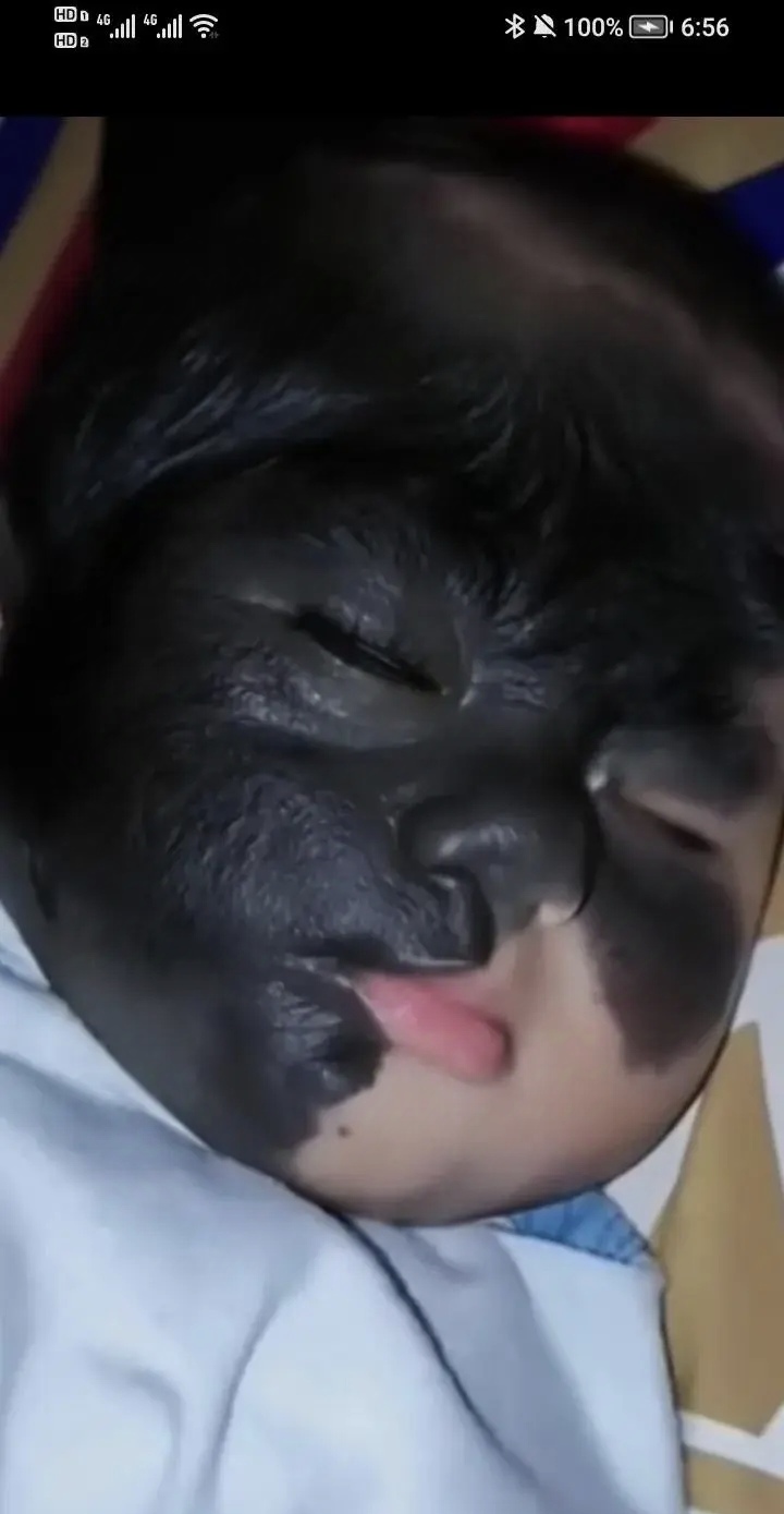 胎记可以遗传人吗?