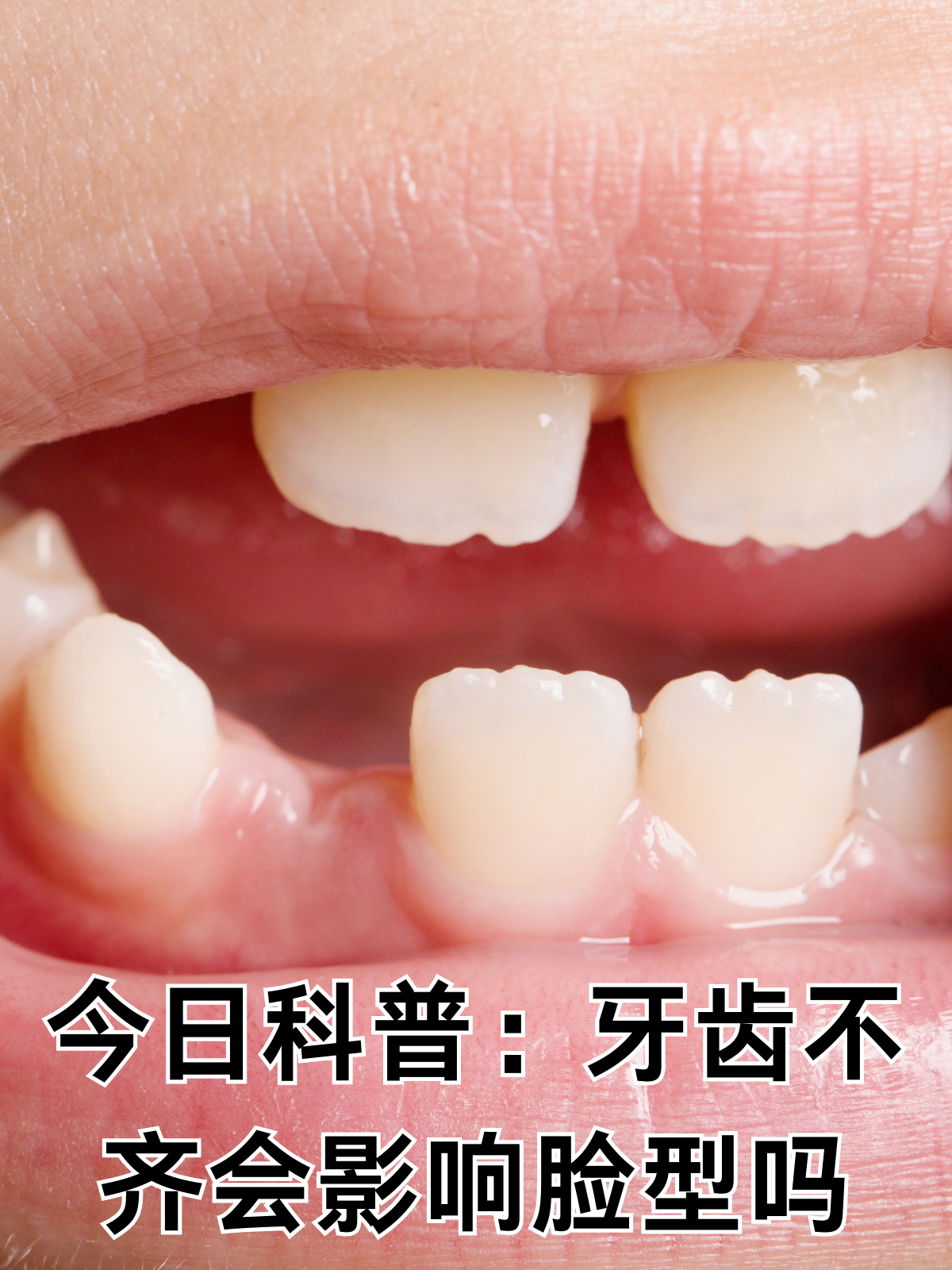 牙列不齐的症状有哪些?