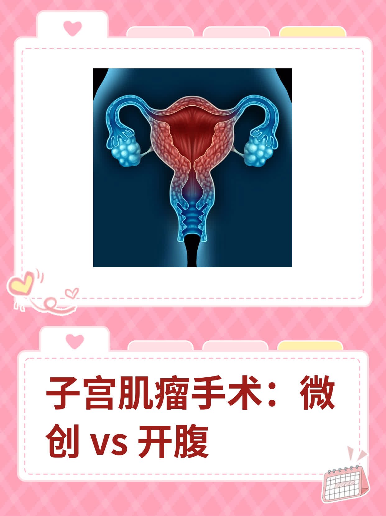 子宫肌瘤要做手术吗