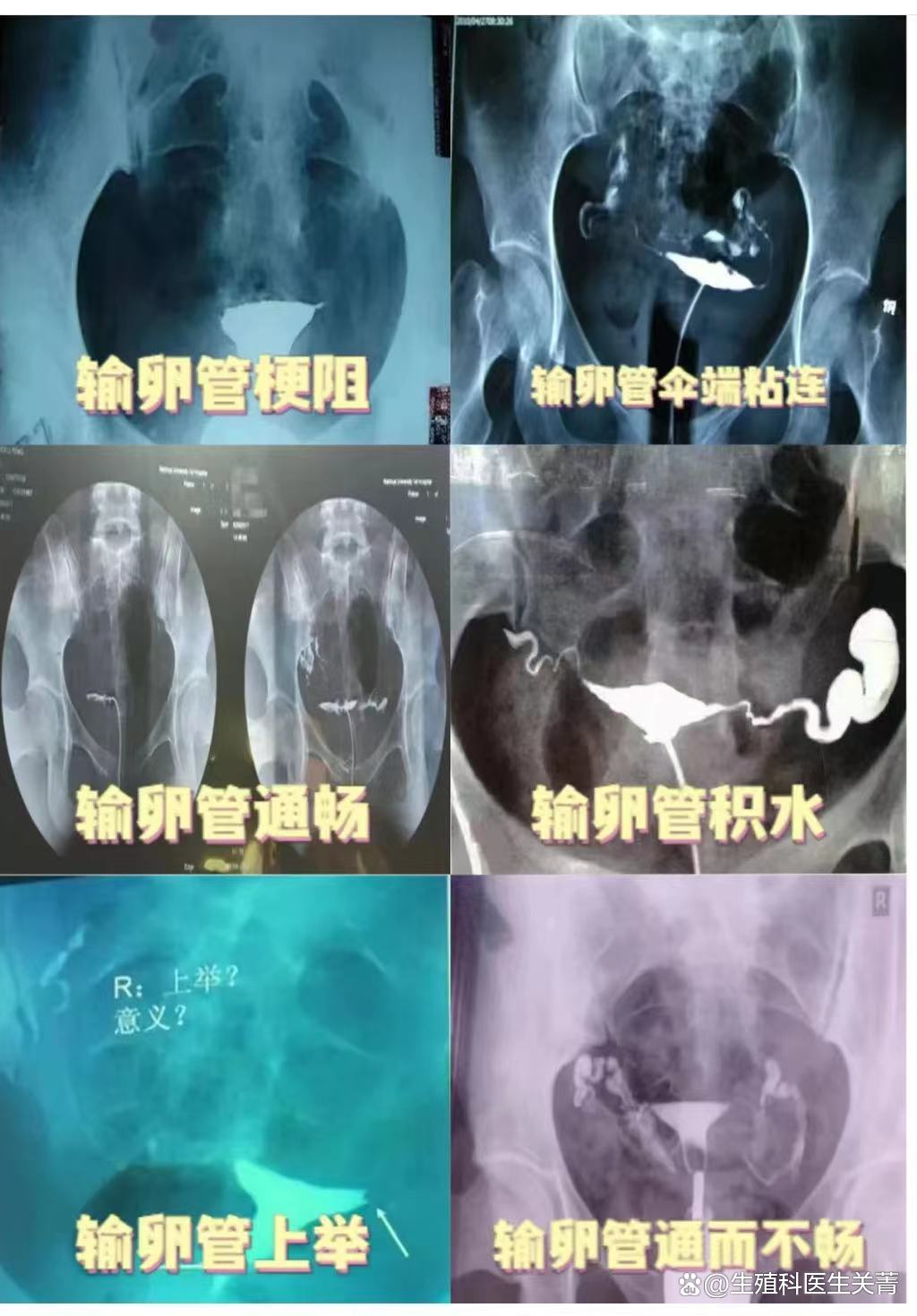 输卵管造影什么时间做