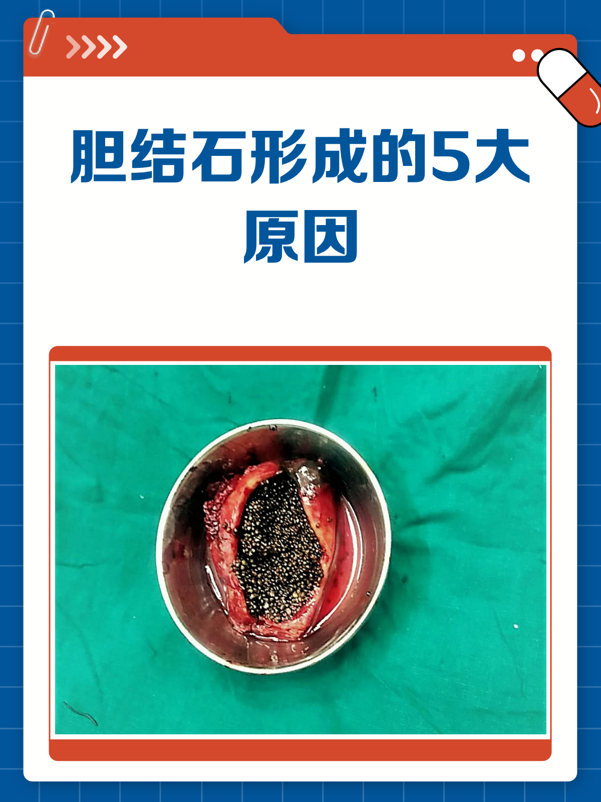 胆结石是哪些原因形成的