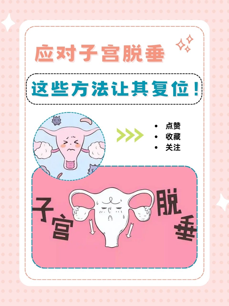 子宫脱垂怎么恢复正常