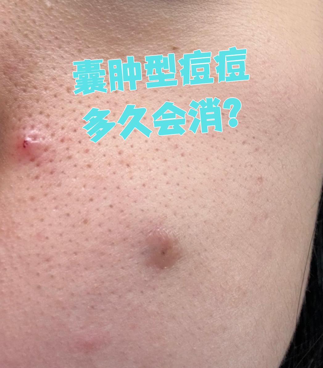 囊肿严重吗