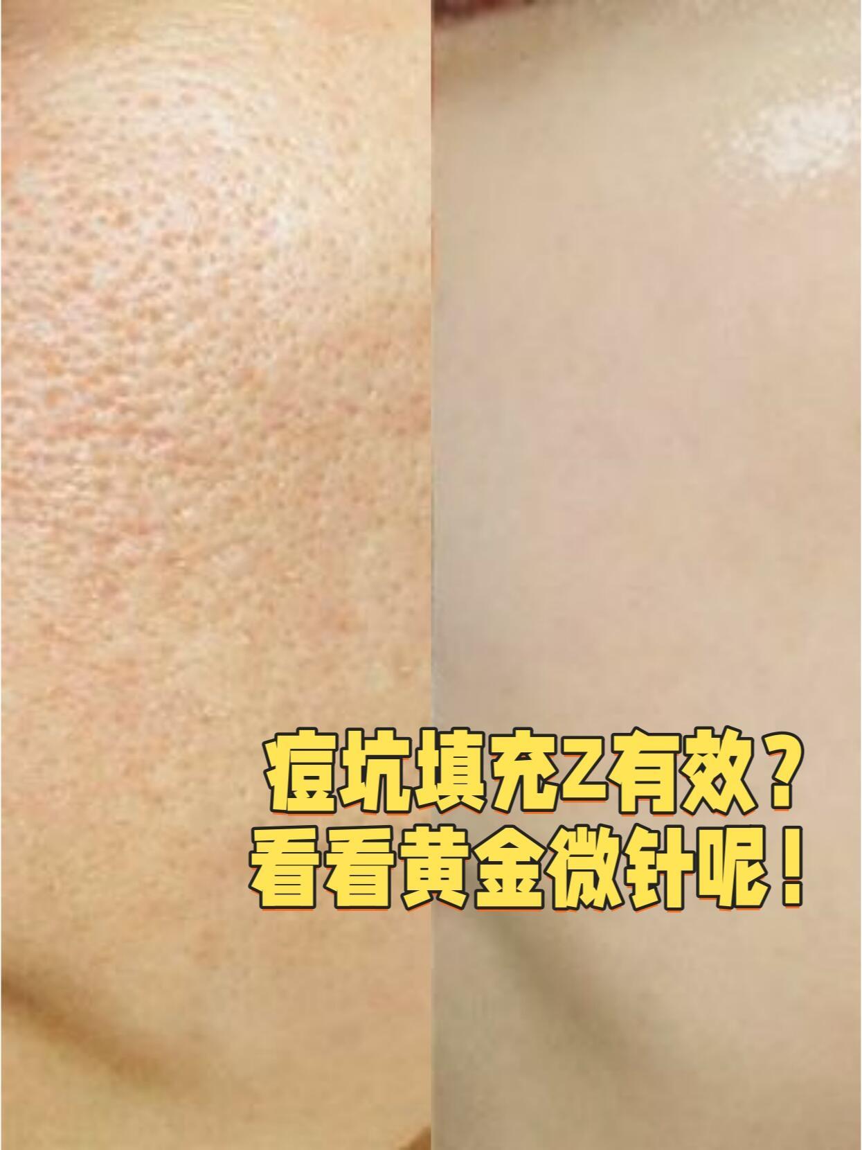 微针治痘坑