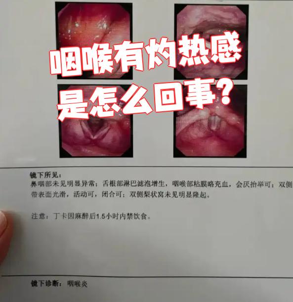 反流性咽喉炎