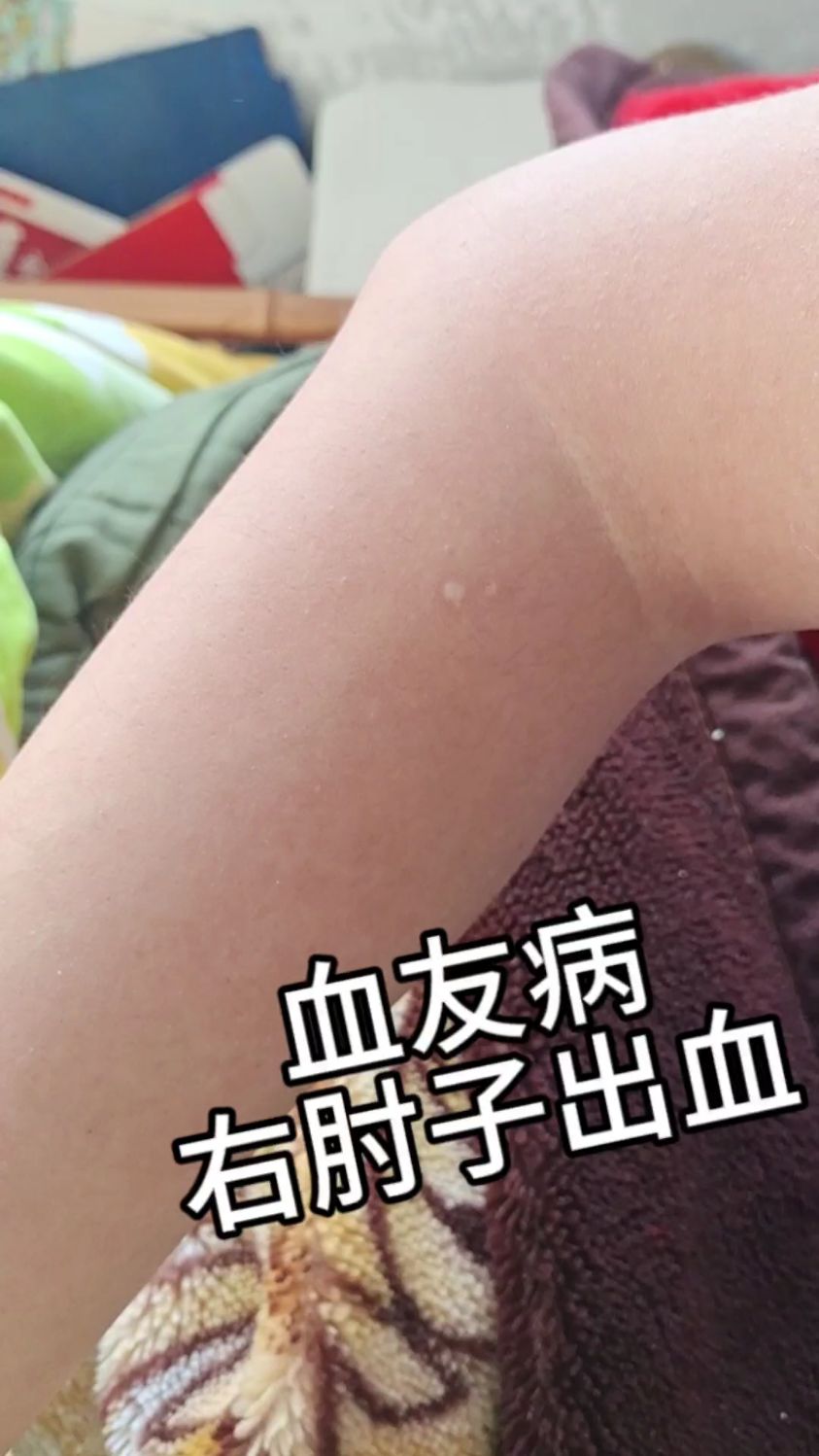 血卟啉病是什么病