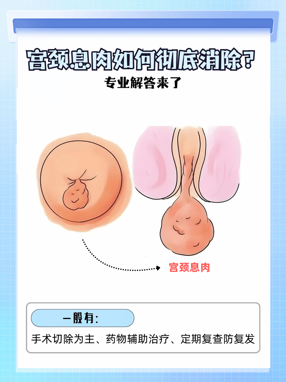 什么是息肉