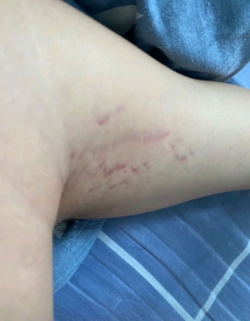 两个腋窝下都有这种圆斑
