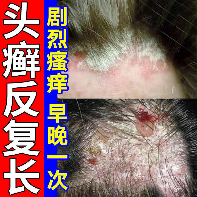 头皮脂溢性皮炎怎么治疗