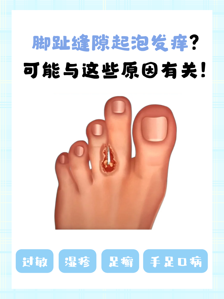 脚上起水泡怎么回事?
