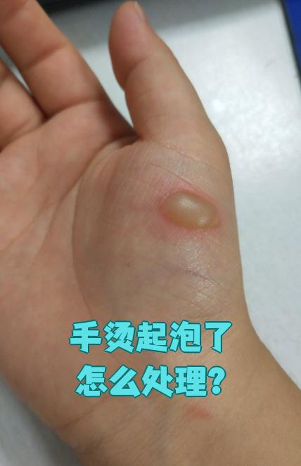手上起泡了怎么办