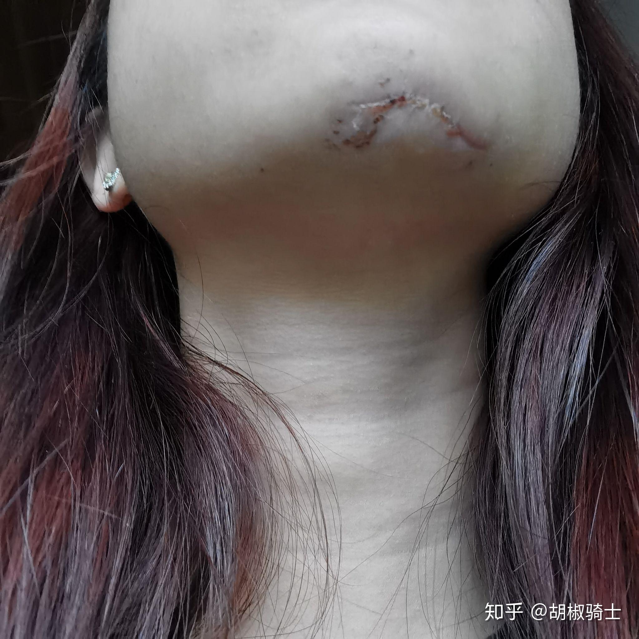 请问激光去红血丝后掉痂后,脸上出现一片片