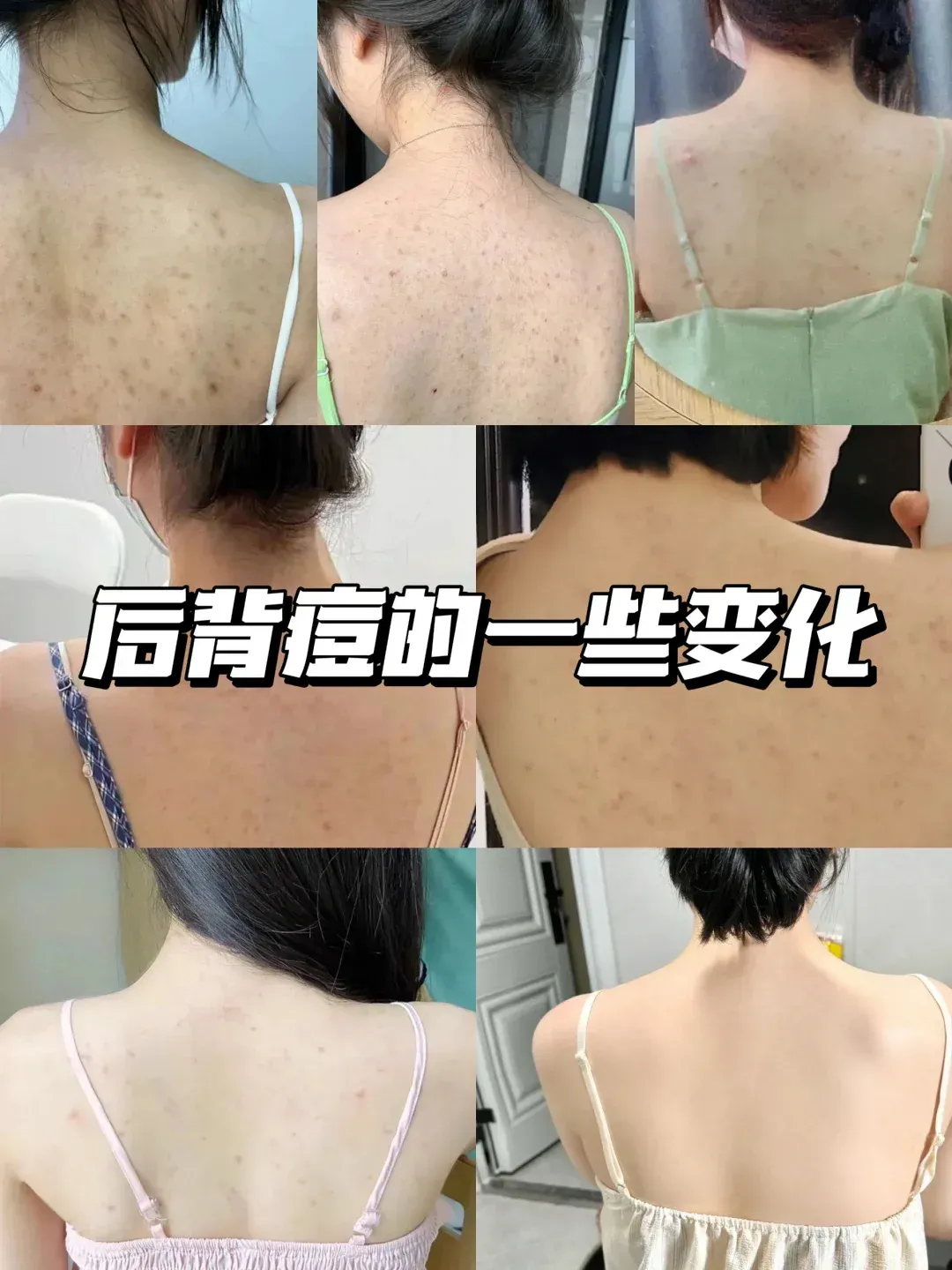 后背长痘怎么办
