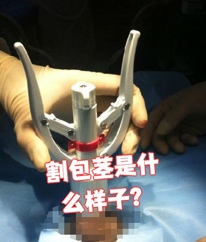 这是我做完包茎手术第三天的图,你看看有问