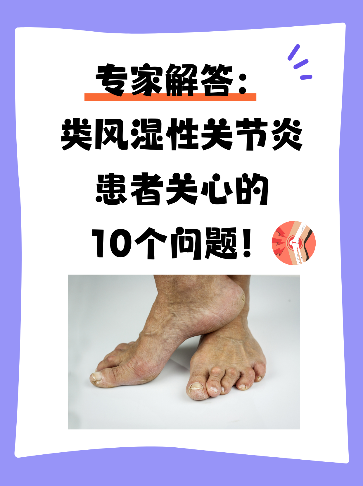 风湿性关节炎能治愈吗