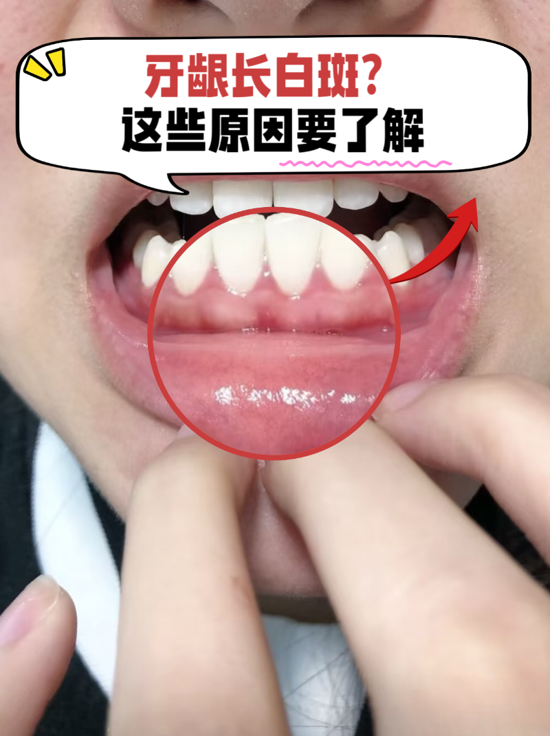 牙齿变白最快的方法