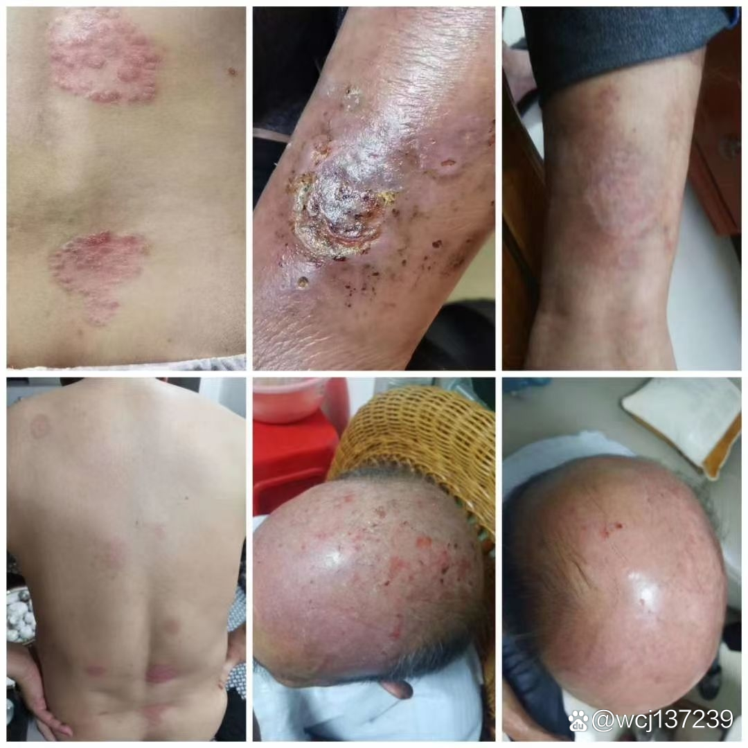 皮肤念珠菌病是由什么原因引起的?