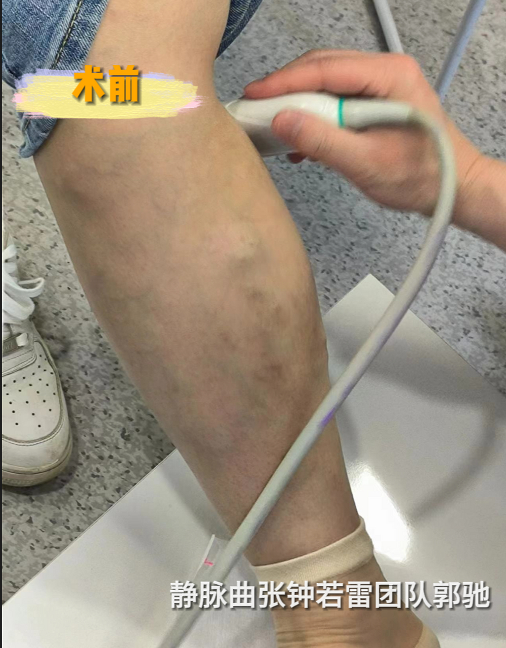 静脉曲张手术后多长时间能恢复正常
