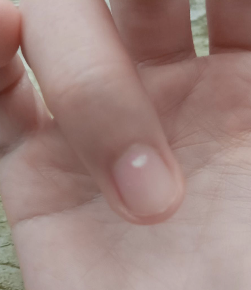 指甲上有白点是什么原因?