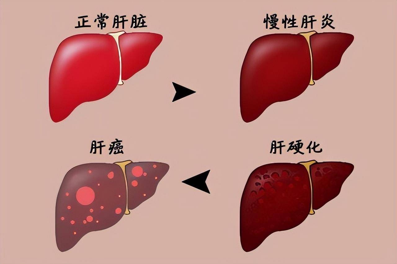 乙肝的症状有哪些