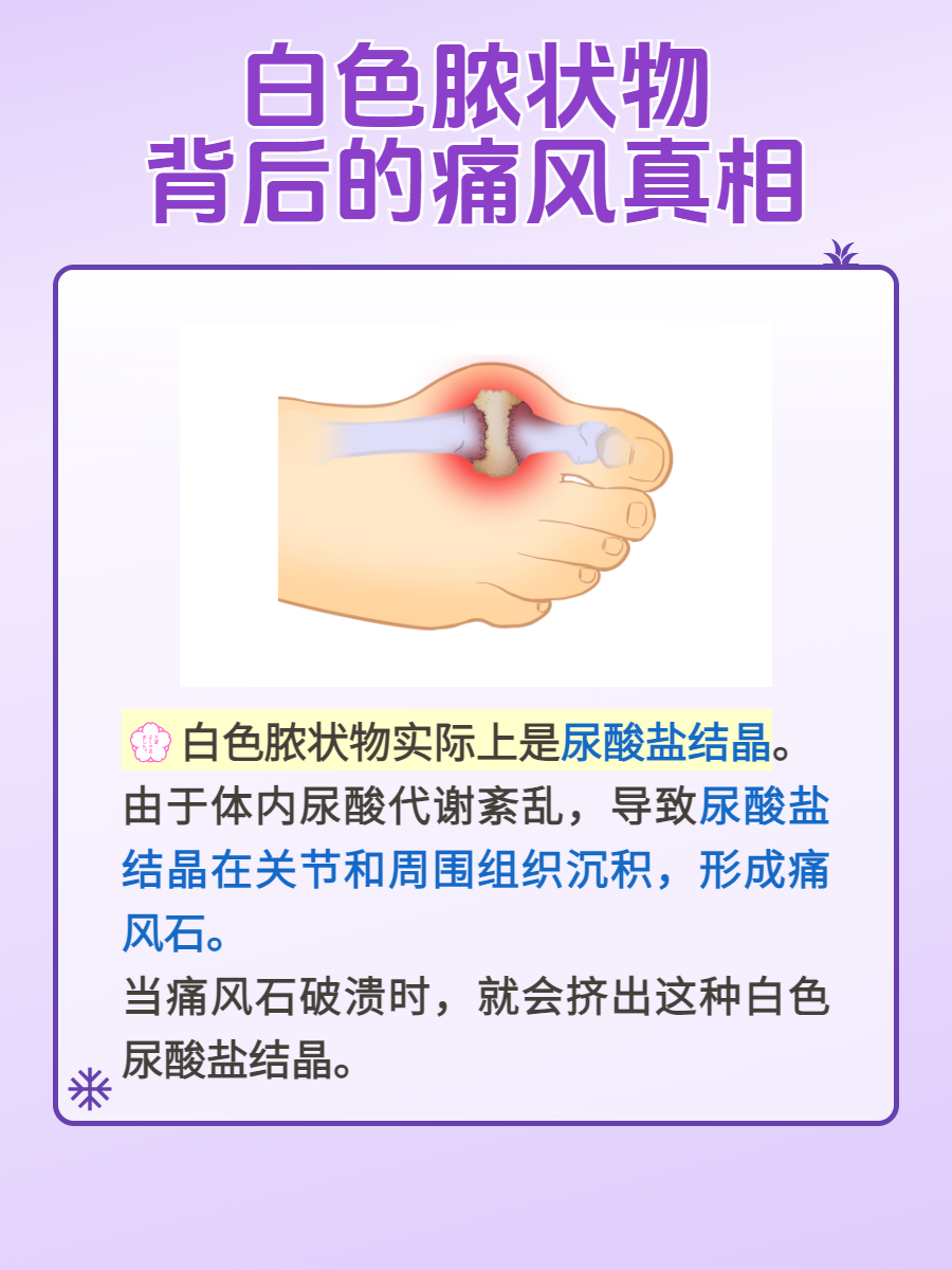 年轻人痛风可以治好吗
