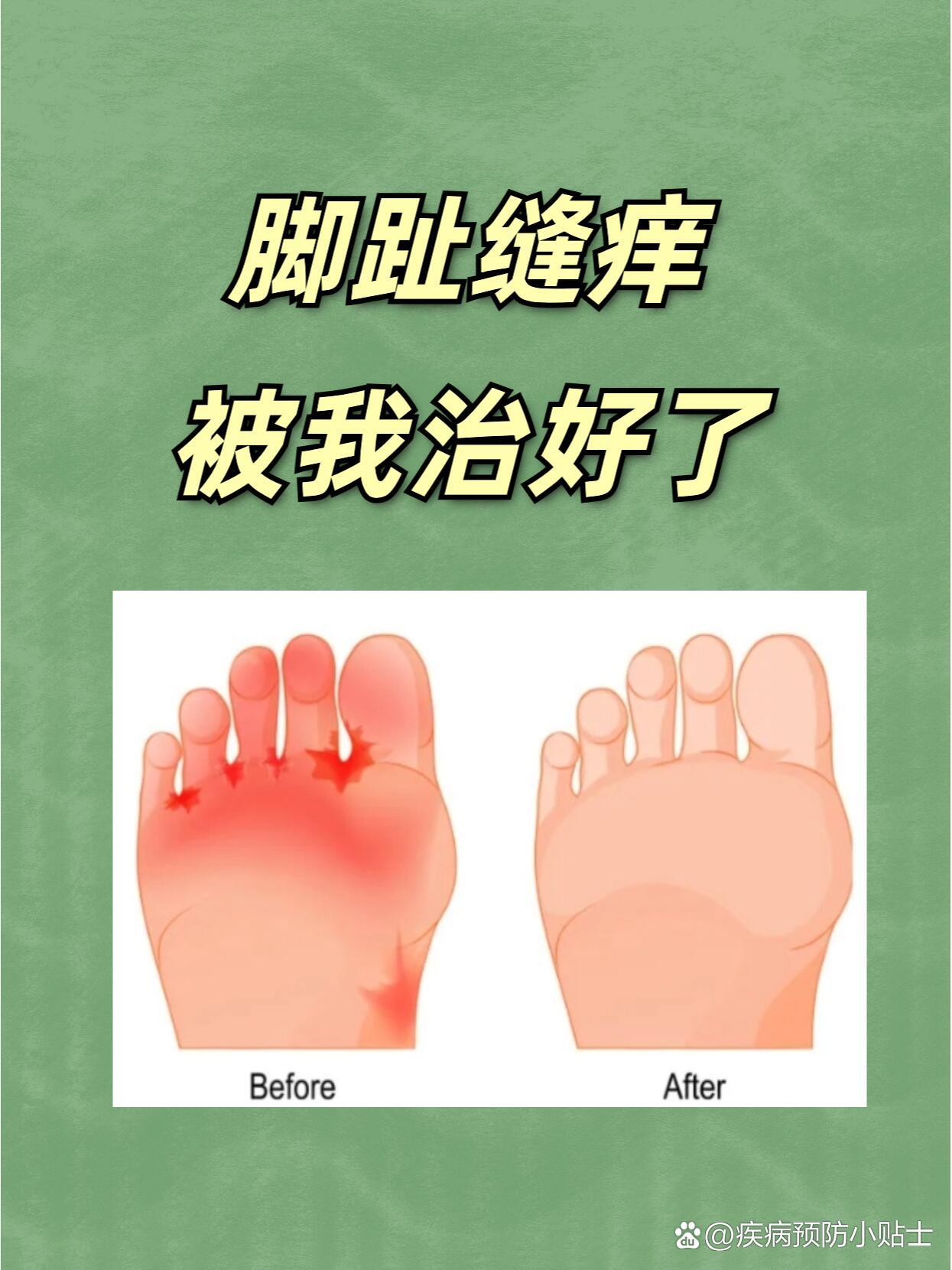 脚趾缝脱皮、发痒,是怎么回事
