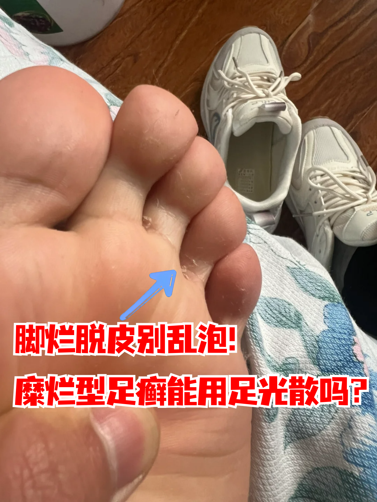 脚趾缝脱皮、发痒,是怎么回事