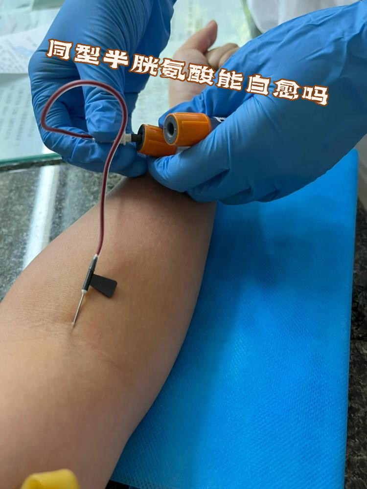 血同型半胱氨酸偏高能治愈吗