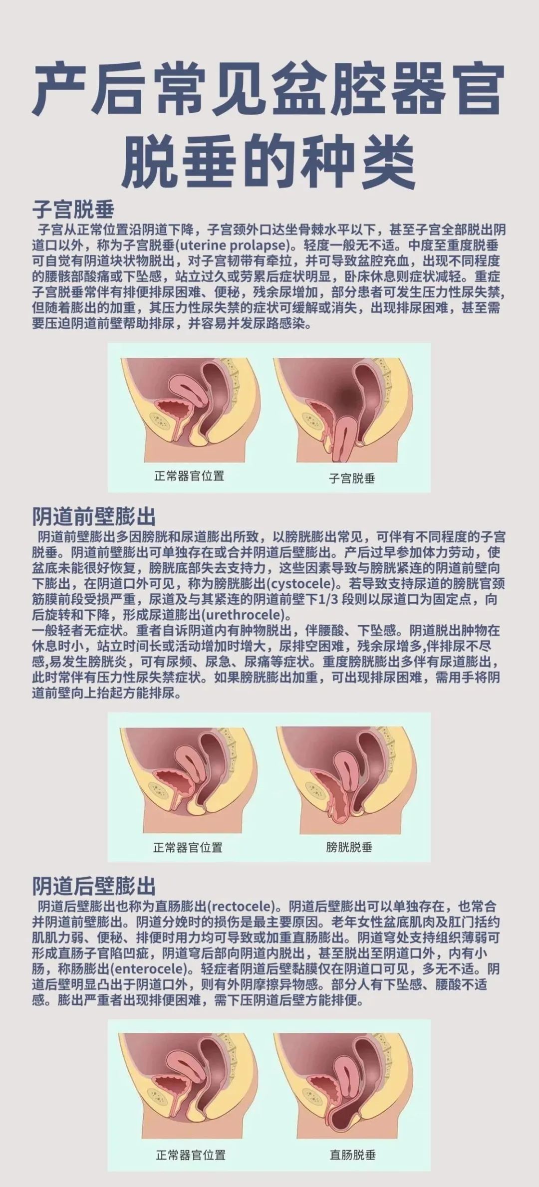 怎么判断子宫是否下垂