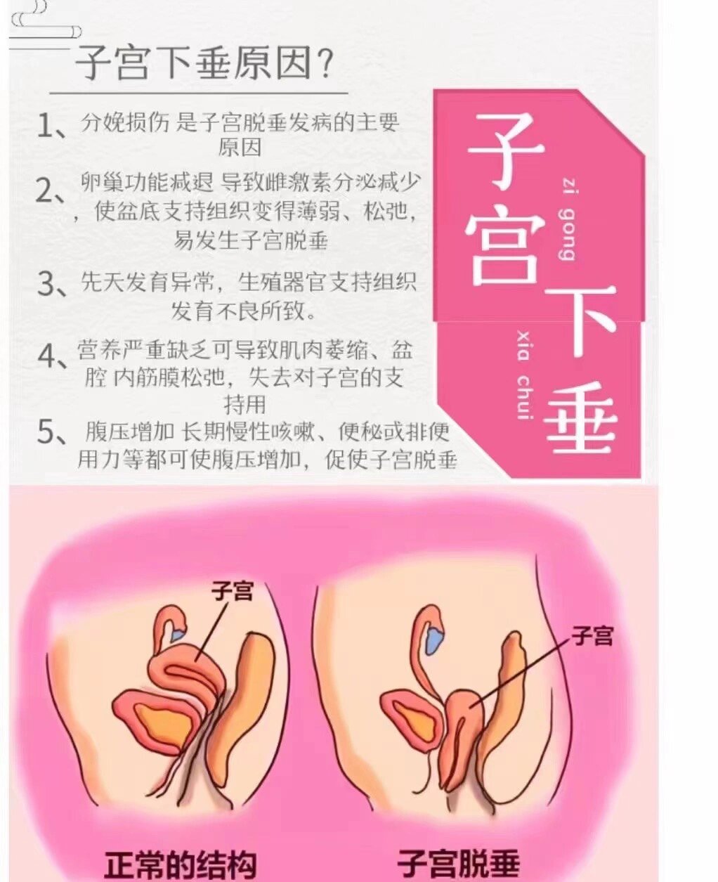 怎么判断子宫是否下垂