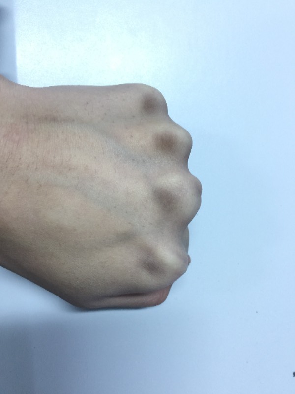 手背关节处发黑很像起茧但是手背没有过什么