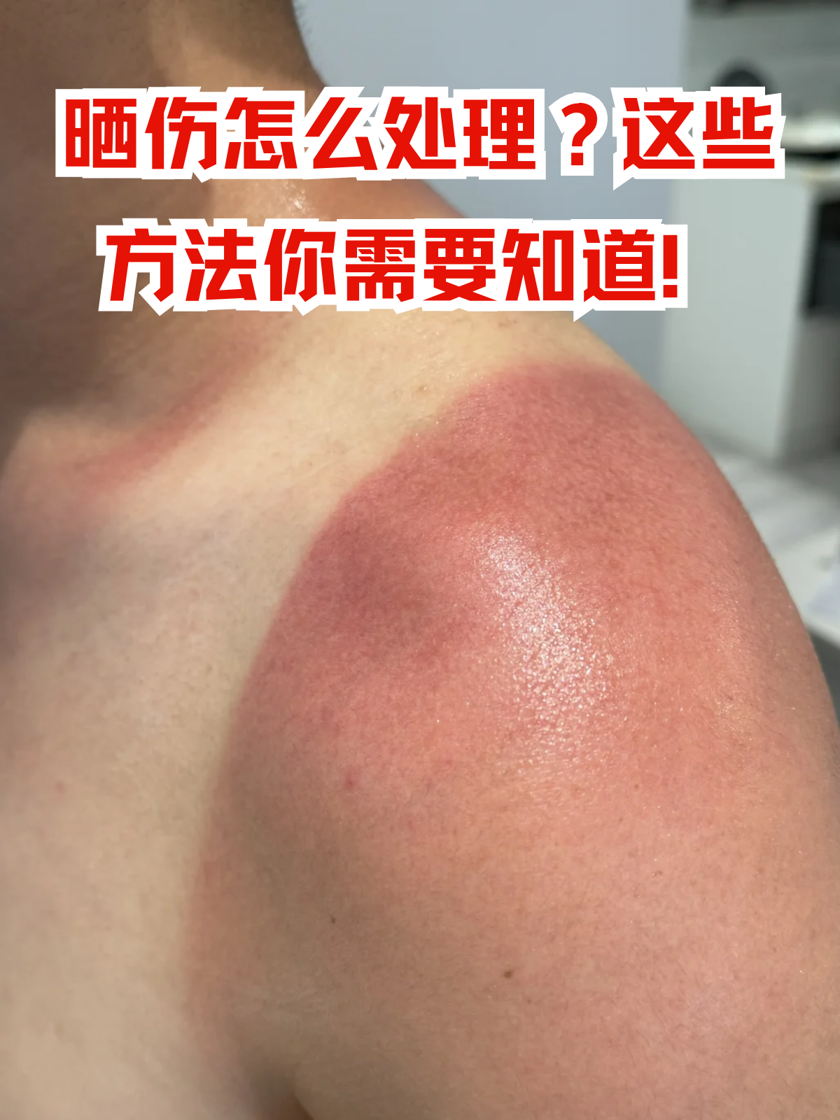 皮肤晒伤脱皮怎么修复