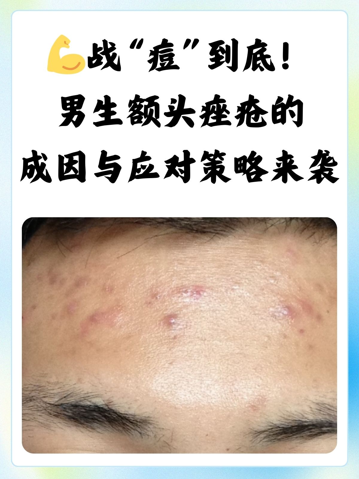 痤疮是哪些原因引发的