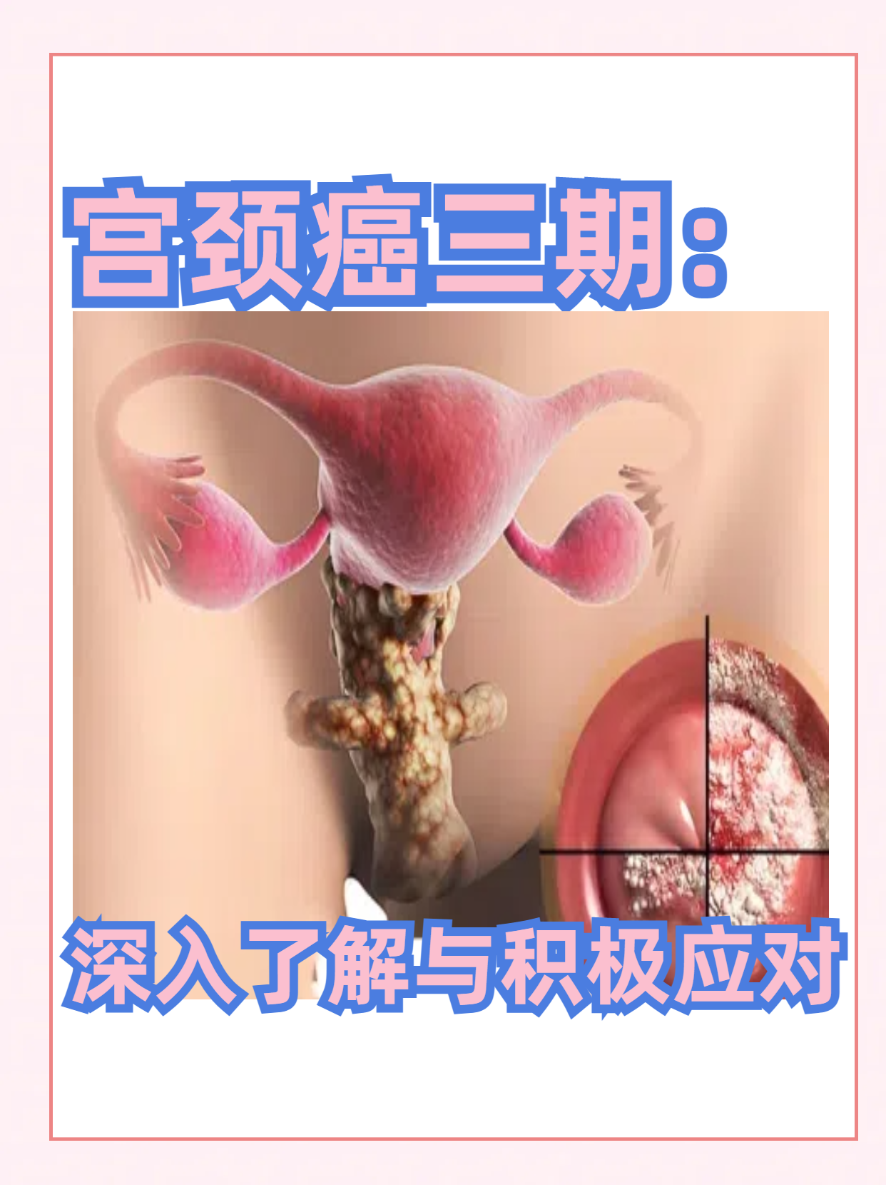 宫颈癌有些什么症状表现?