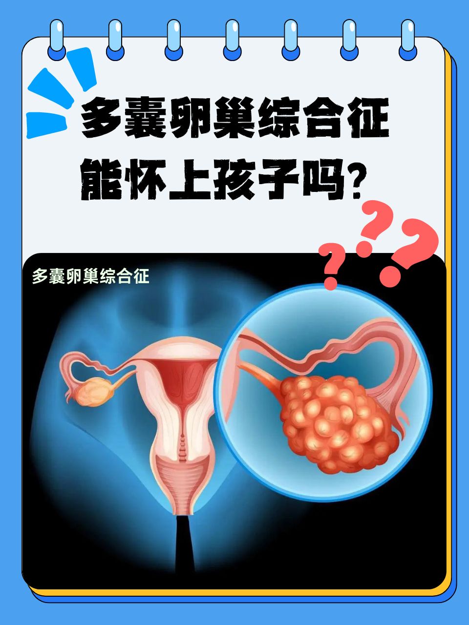 多囊卵巢是怎么引起来的