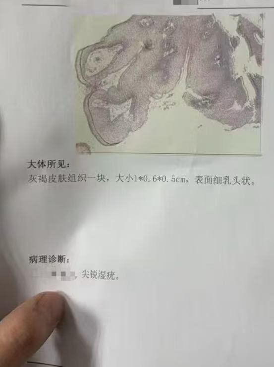 尿道口长得这个小肉芽是什么喔