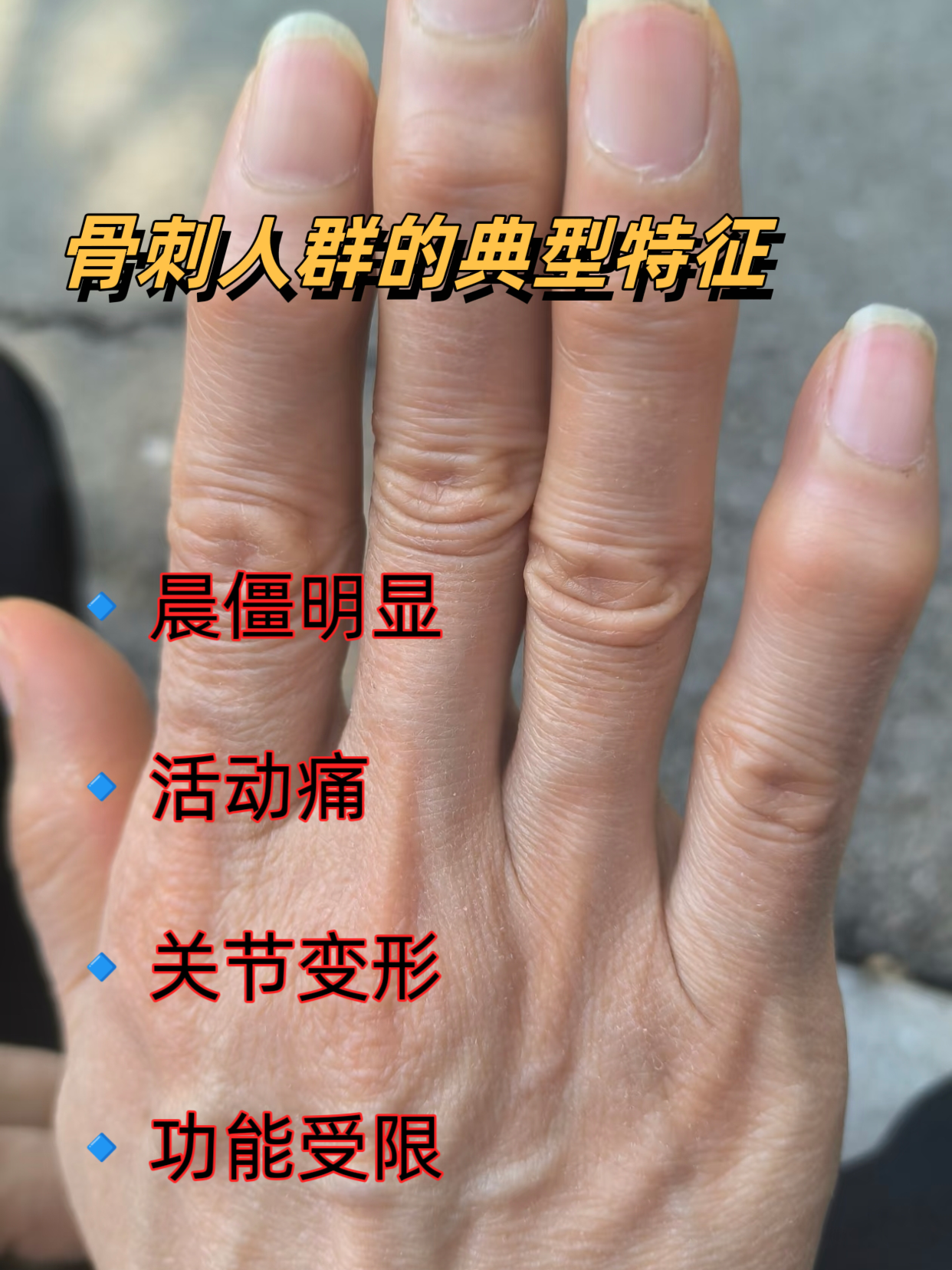 骨刺是什么???