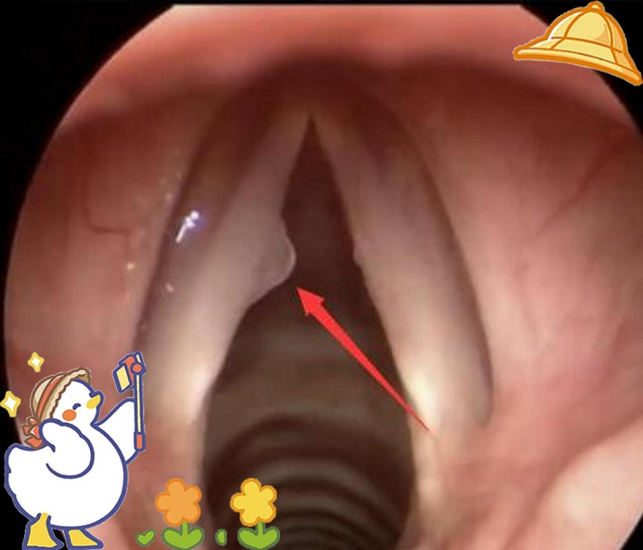 声带息肉有几种手术方法