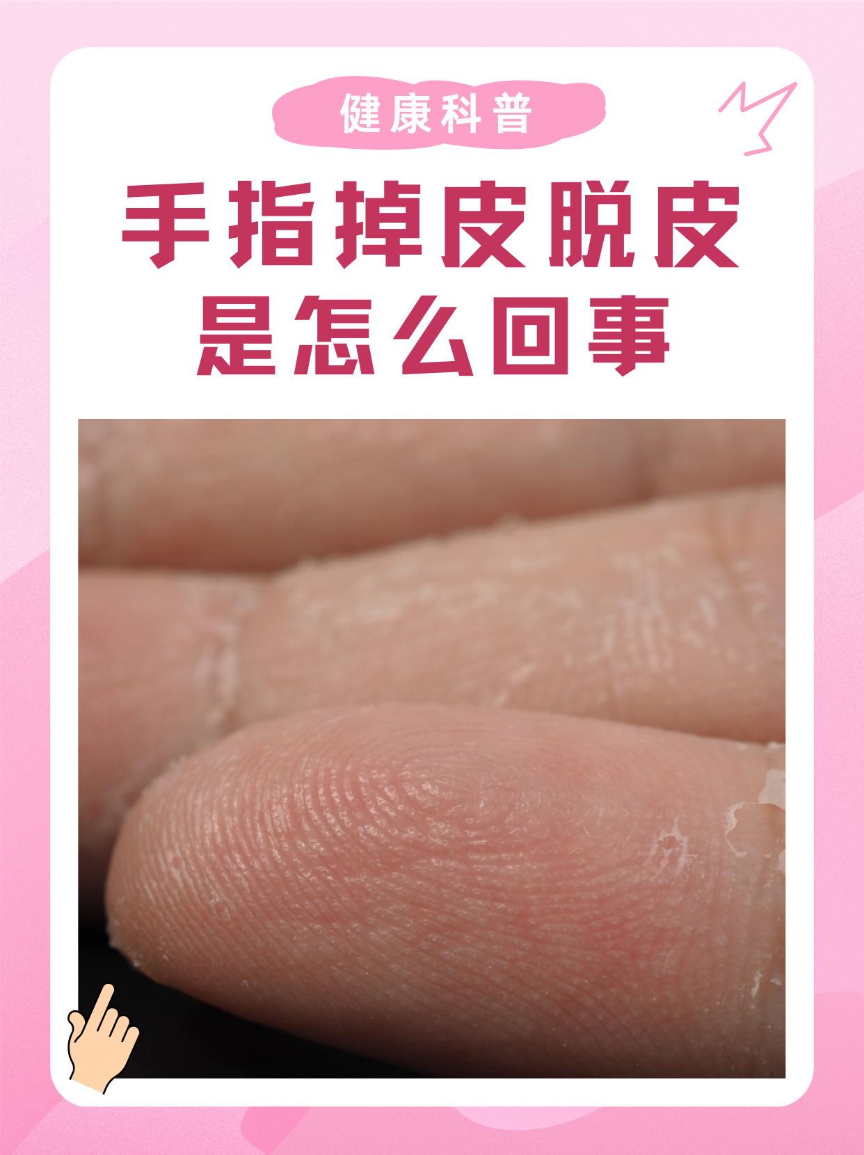 手指头脱皮,什么原因