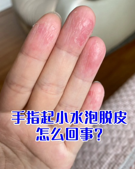手指头脱皮,什么原因