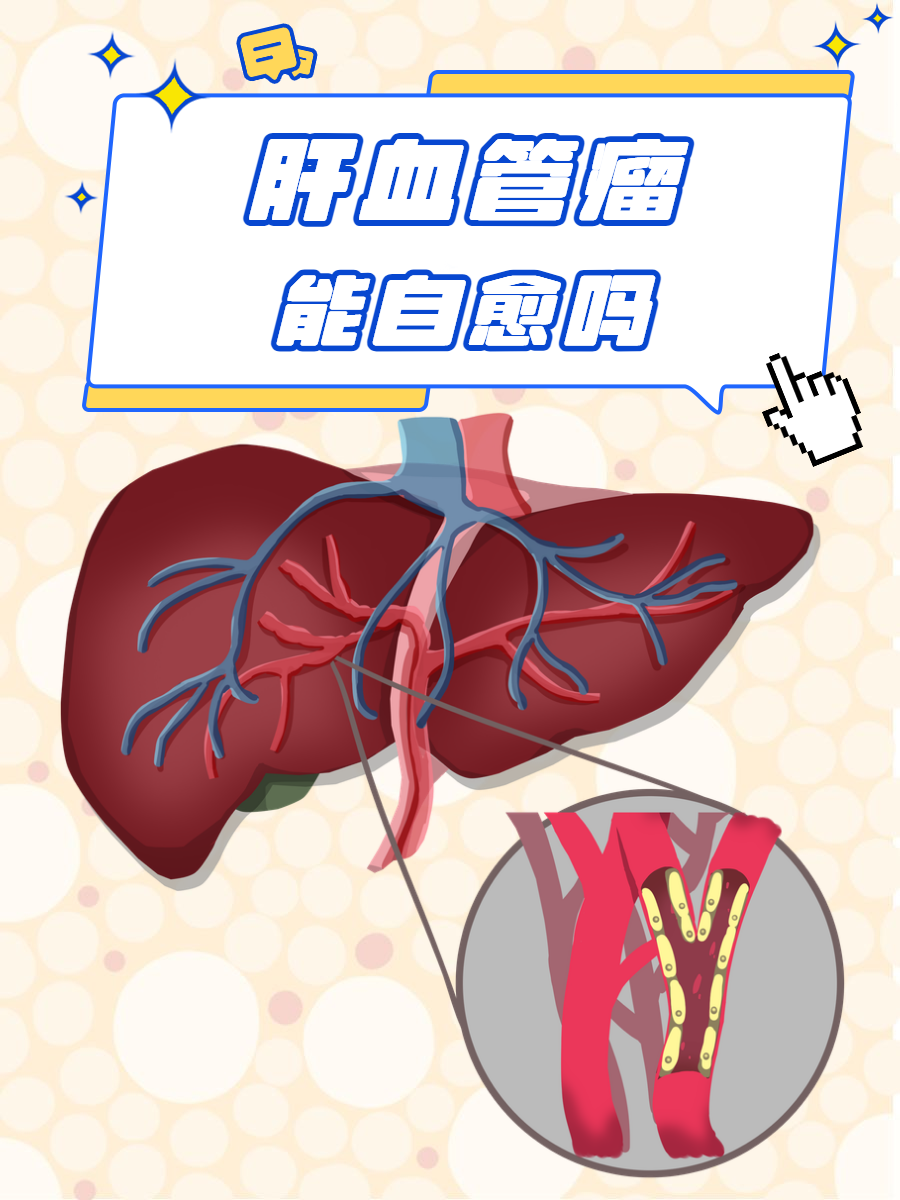 肝血管瘤会转化成肝癌吗?