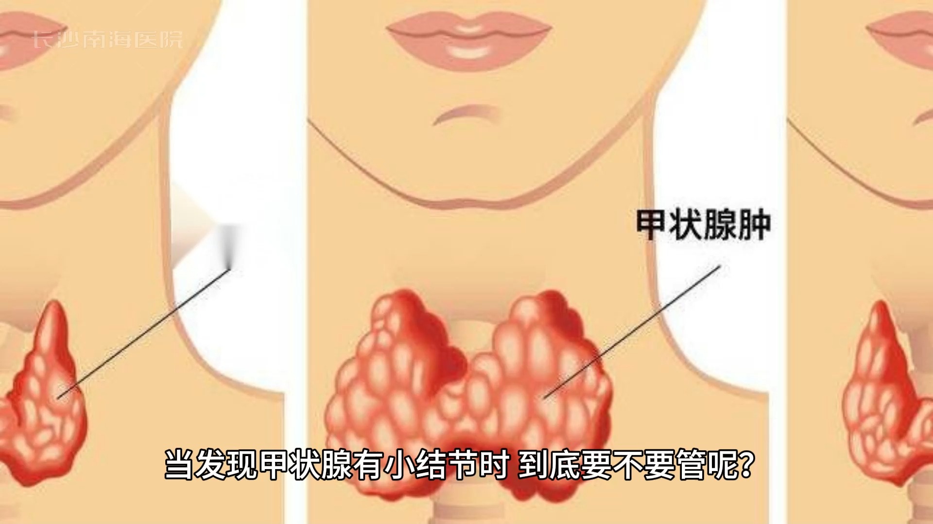 甲状腺肿的介绍