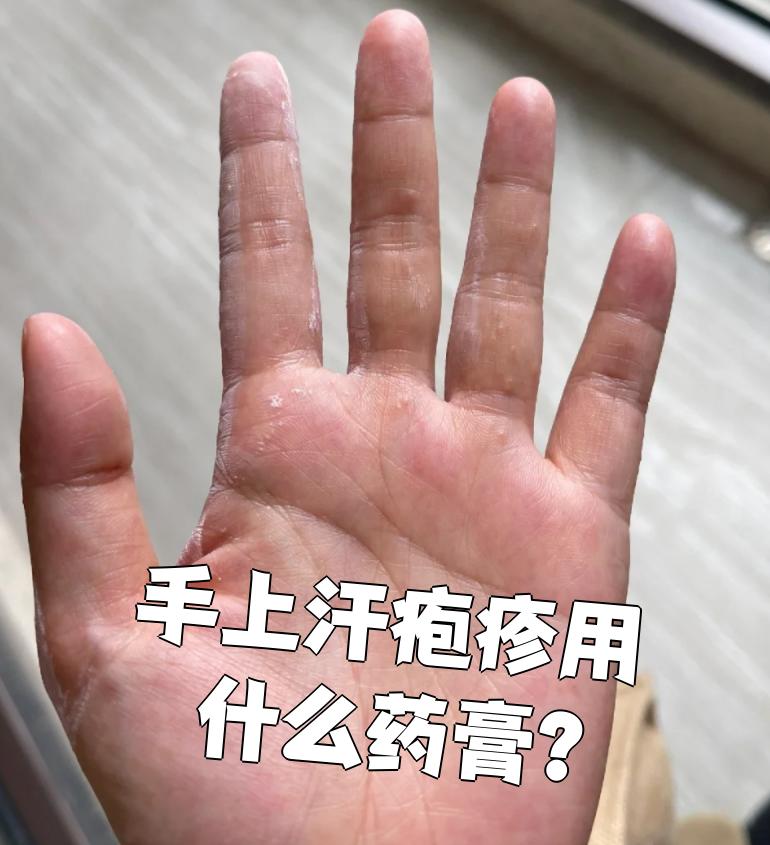 汗疱湿疹用什么药最快