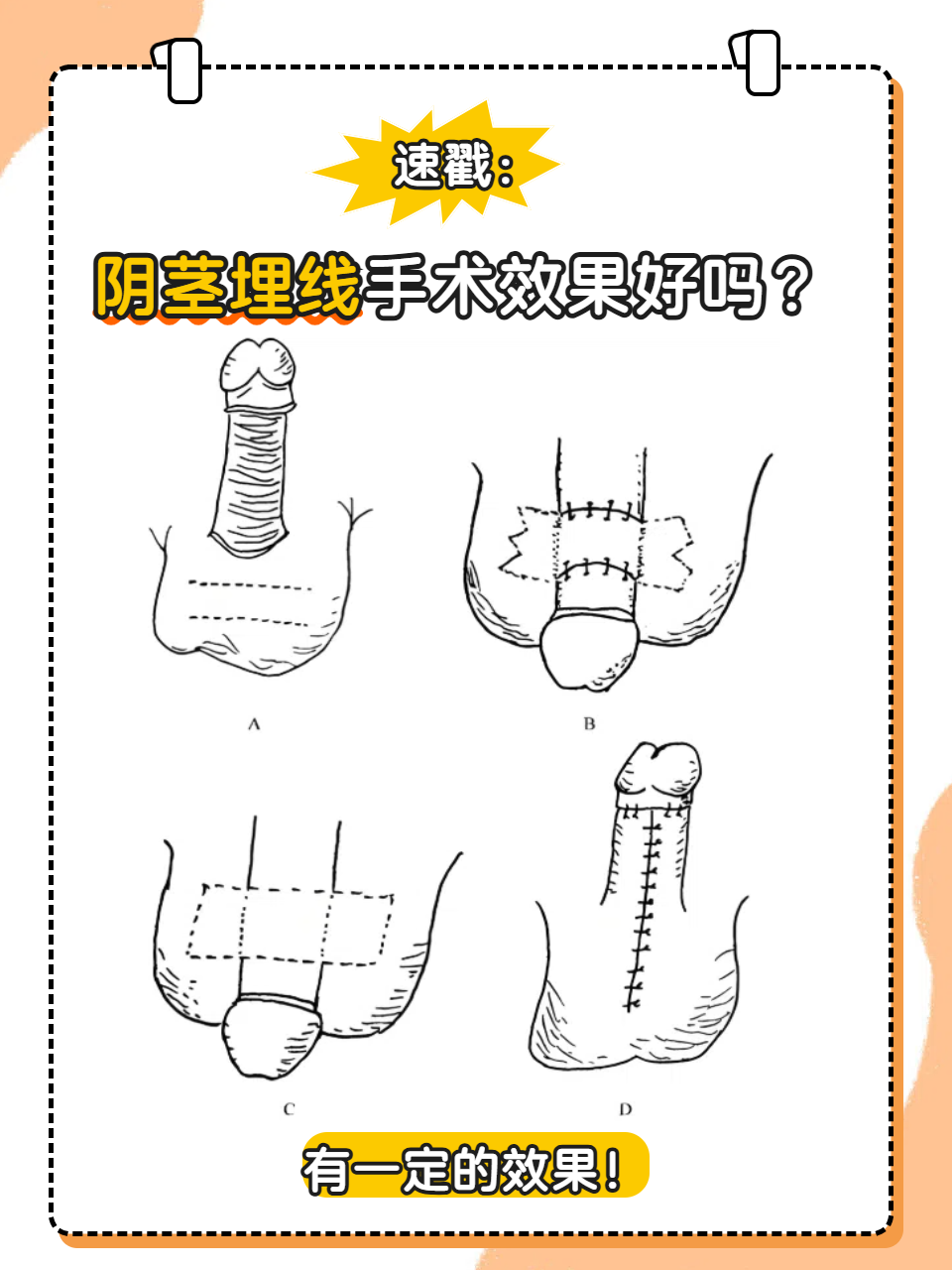 割掉包皮后早泄会好吗